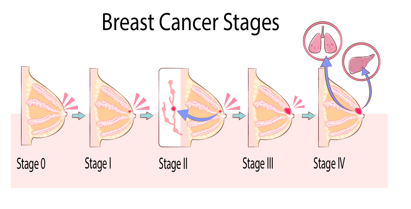 Methodist Healthcare provides a detailed description of breast cancer stages that help determine optimal treatment options.